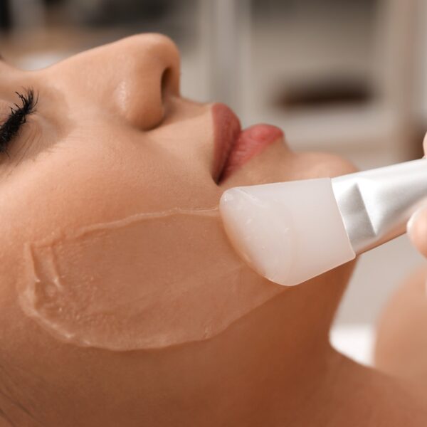 chemical peel