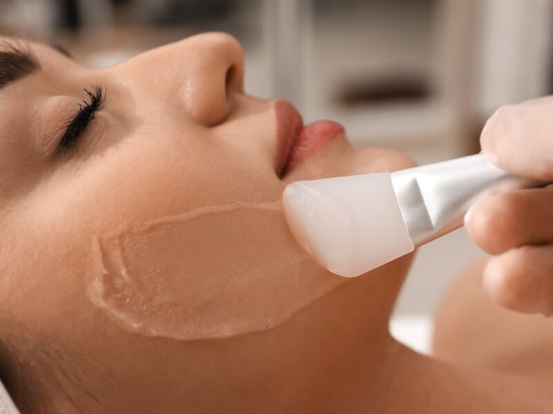 chemical peel